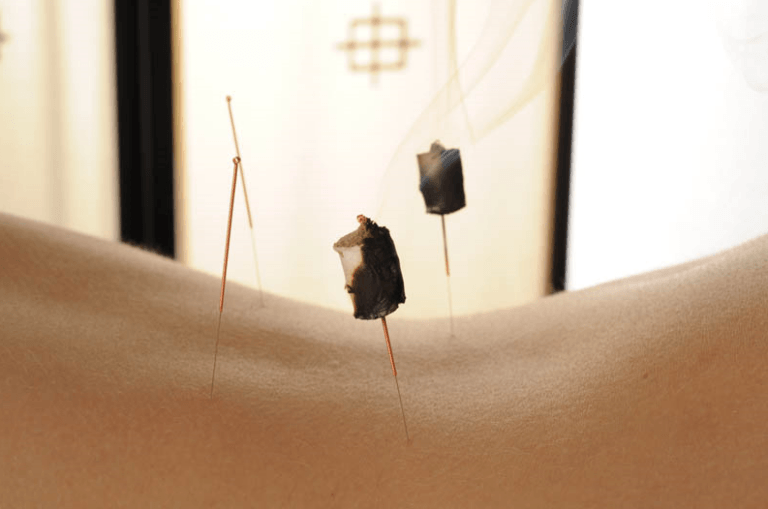 Aiguille d'acupuncture utilisée en médecine traditionnelle chinoise par Michael Cardot