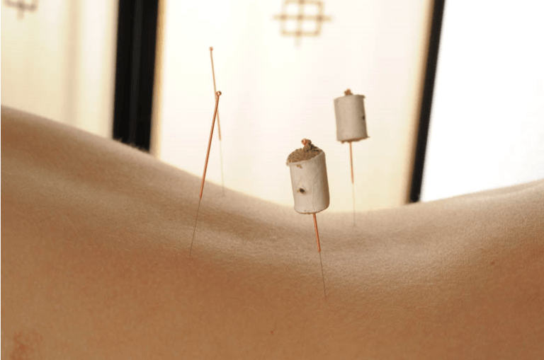 Séance d'acupuncture en médecine traditionnelle chinoise