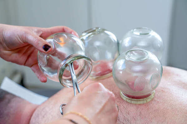 Séance de cupping avec application de ventouses thérapeutiques
